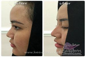 Filler Hidung / Nose Filler