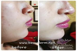 Chin Augmentation / Filler Dagu