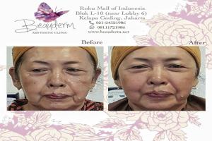 Mid Face Filler