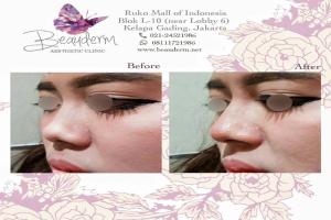 Filler Hidung / Nose Filler
