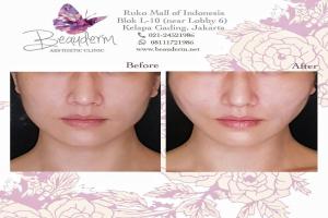 Tarik Benang (Threadlift)