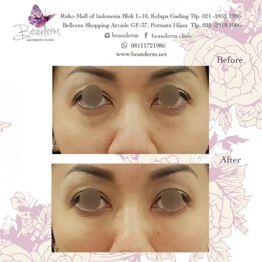 Under Eye Filler