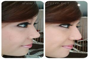 Filler Hidung / Nose Filler