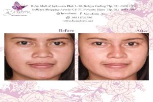 Filler Hidung / Nose Filler