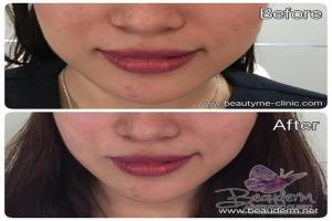 Tarik Benang (Threadlift)