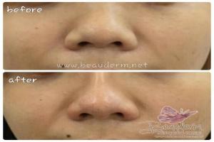 Filler Hidung / Nose Filler