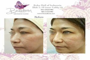 Filler Hidung / Nose Filler