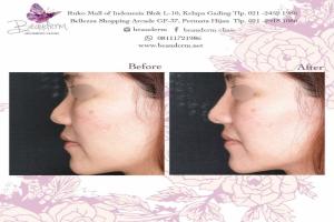 Filler Hidung / Nose Filler