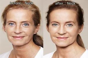 Neck Rejuvenation
