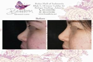Filler Hidung / Nose Filler