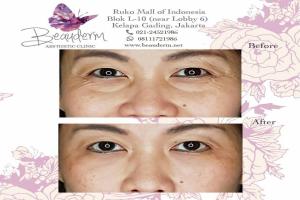 Under Eye Filler