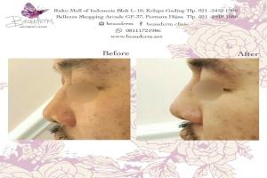 Filler Hidung / Nose Filler