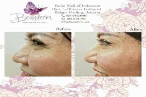 Under Eye Filler