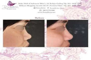 Filler Hidung / Nose Filler