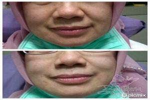 Smile Line Filler