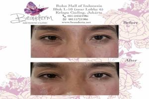Under Eye Filler