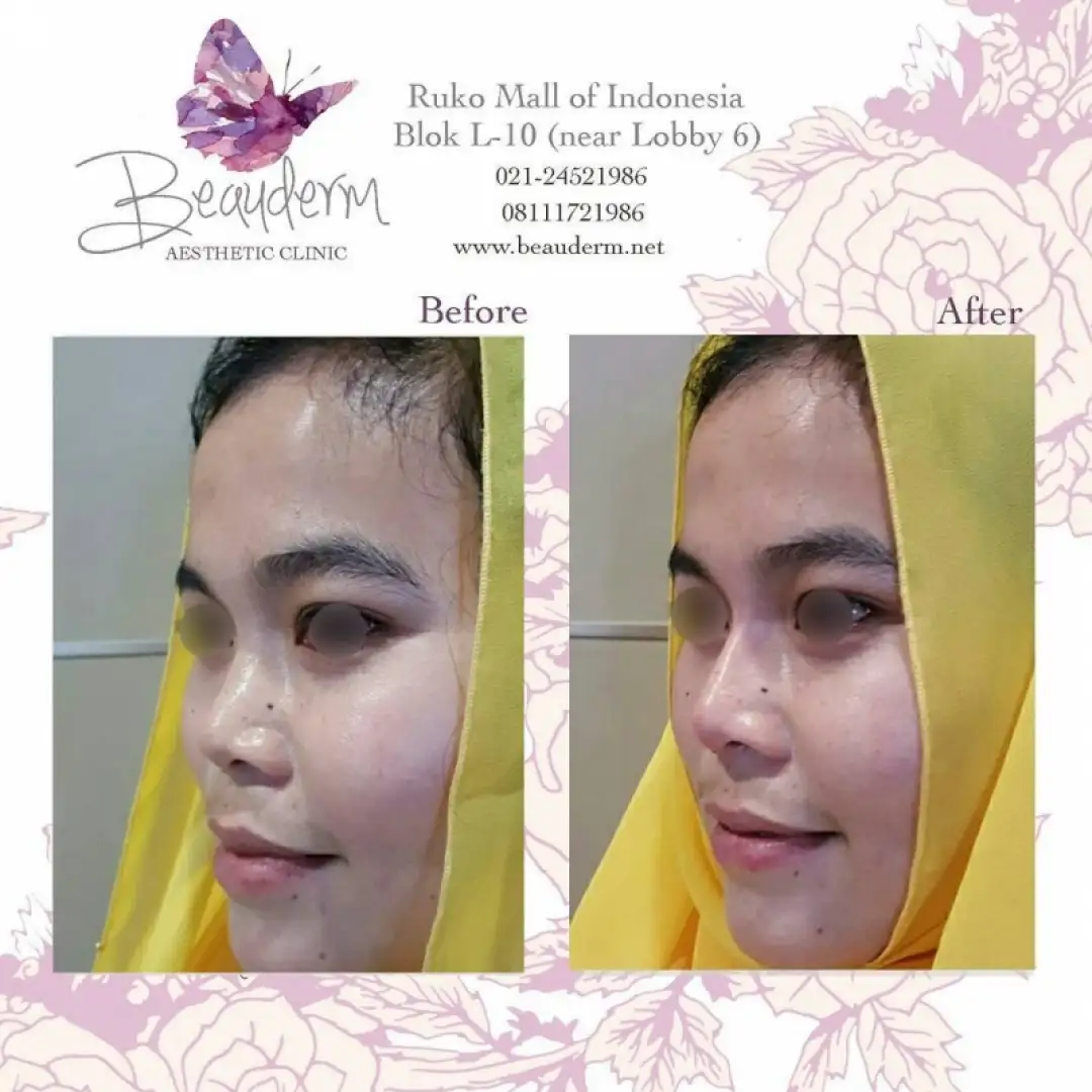 Filler Hidung / Nose Filler