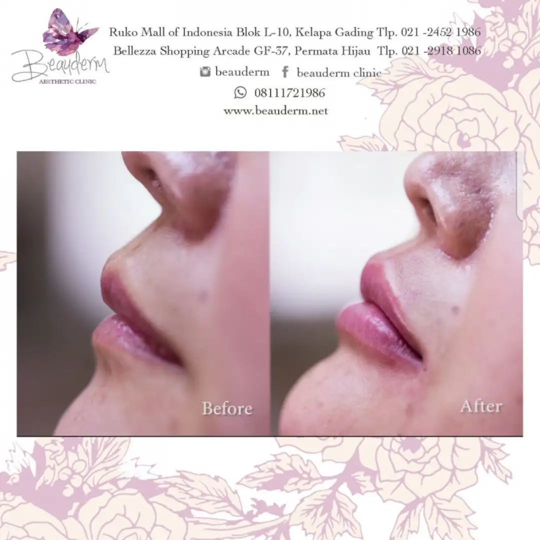 Lips Filler / Filler Bibir