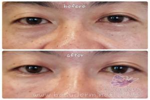 Under Eye Filler