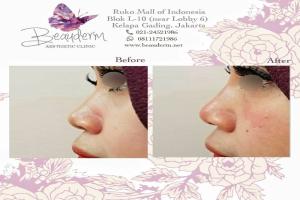 Filler Hidung / Nose Filler