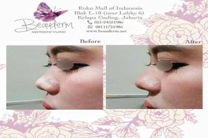 Filler Hidung / Nose Filler