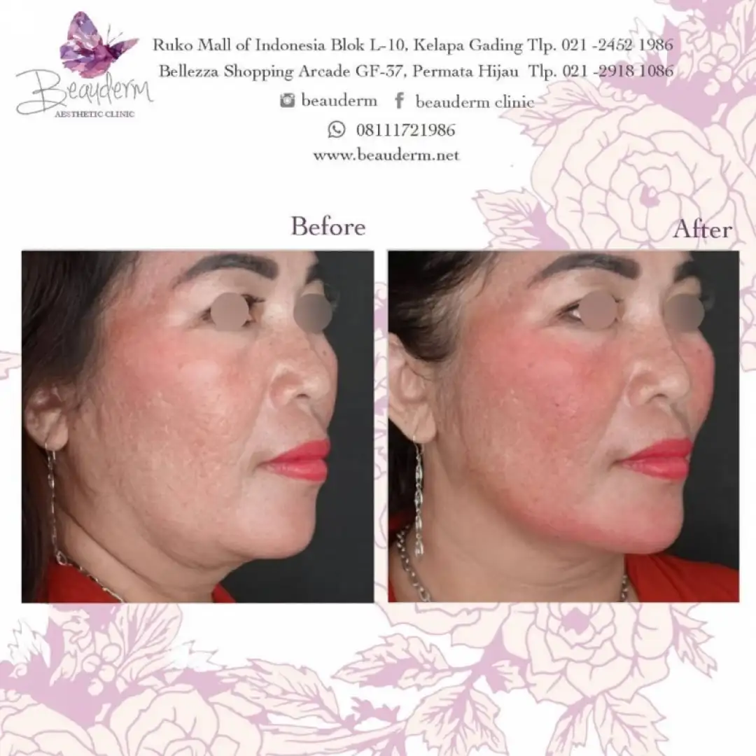 Chin Augmentation / Filler Dagu