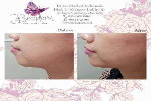Chin Augmentation / Filler Dagu