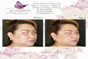 Filler Hidung / Nose Filler