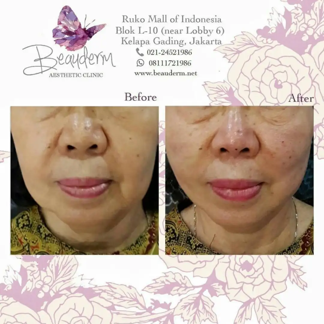Tarik Benang (Threadlift)