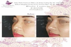 Filler Hidung / Nose Filler
