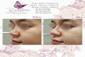 Filler Hidung / Nose Filler