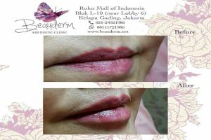 Lips Filler / Filler Bibir