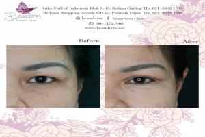 Double Eyelid Stitching