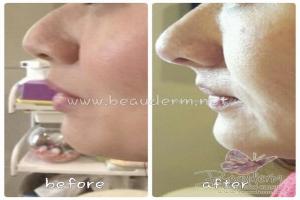Filler Hidung / Nose Filler