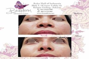 Filler Hidung / Nose Filler