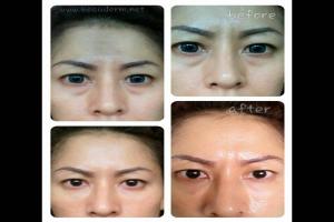 Under Eye Filler