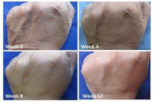 Hand Rejuvenation