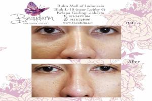 Under Eye Filler
