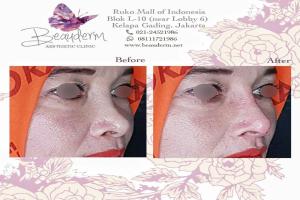 Filler Hidung / Nose Filler