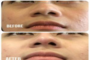 Filler Hidung / Nose Filler