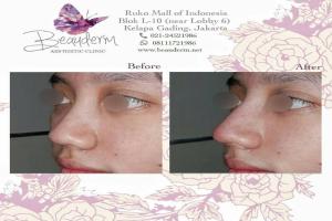 Filler Hidung / Nose Filler