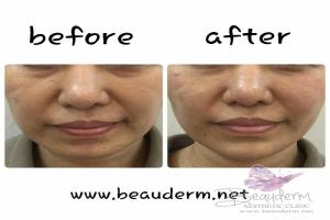 Tarik Benang (Threadlift)