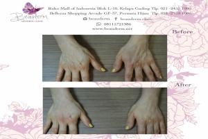 Hand Rejuvenation