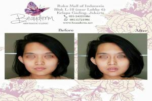 Filler Hidung / Nose Filler