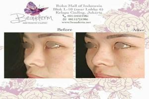 Filler Hidung / Nose Filler