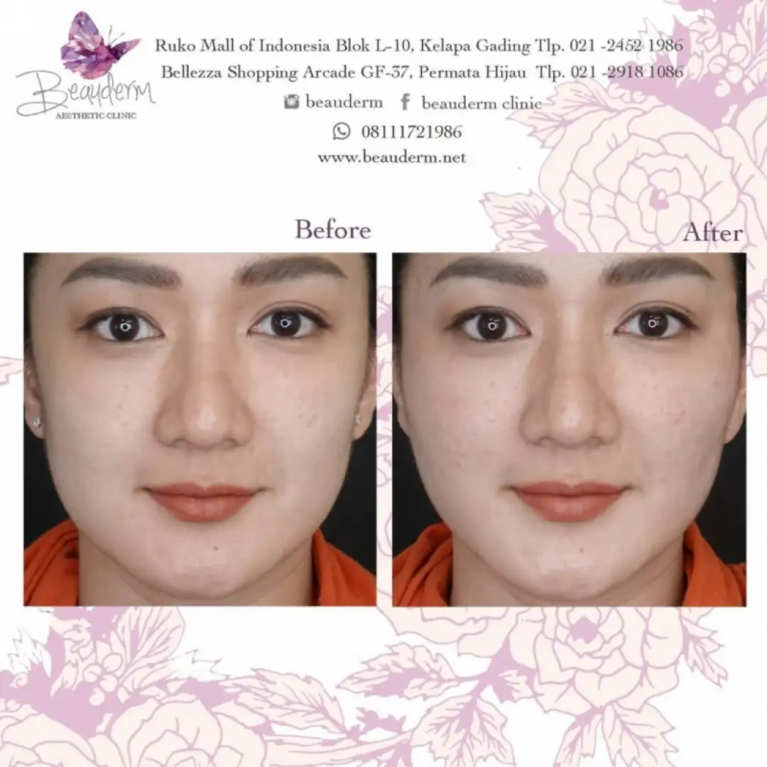 Tarik Benang (Threadlift)