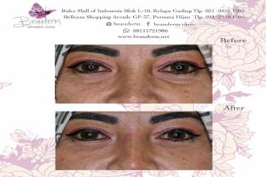 Under Eye Filler