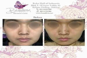 Cheek Augmentation / Filler Pipi