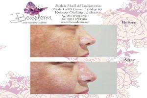 Filler Hidung / Nose Filler