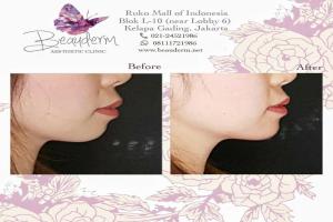 Chin Augmentation / Filler Dagu